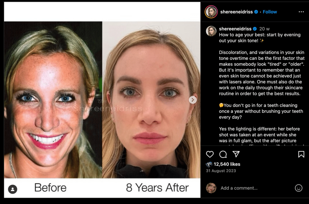 Screenshot of an Instagram post with a medical before-and-after; it showcases 2 pictures of the same woman