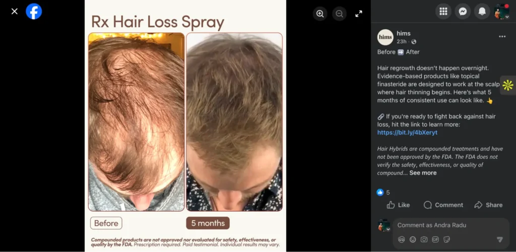 Side-by-side photos showing the top of a person’s head before and after five months of hair regrowth treatment.